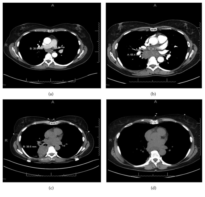 Mediastinal Infection