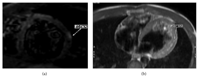 Myocarditis