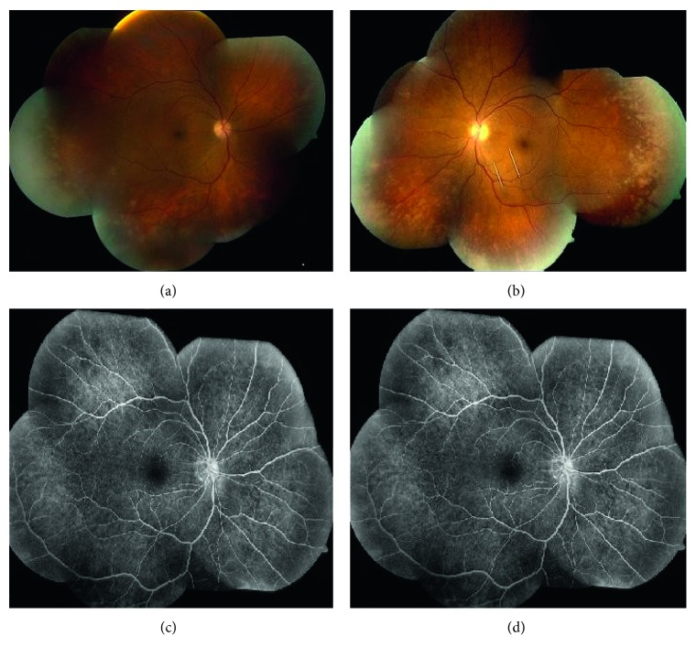 Varicella Zoster Meningitis