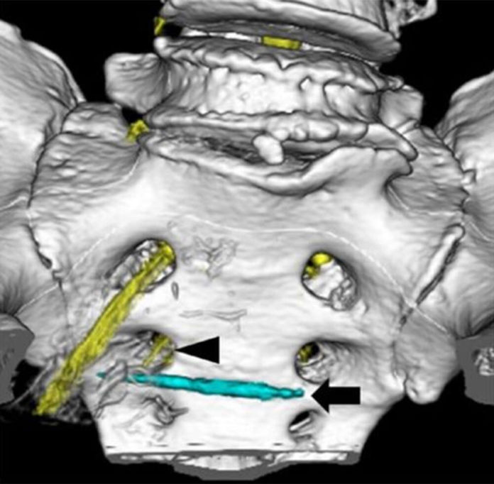 Toothpick discovered in rectum