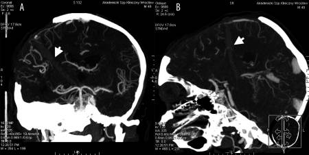 CT angiography