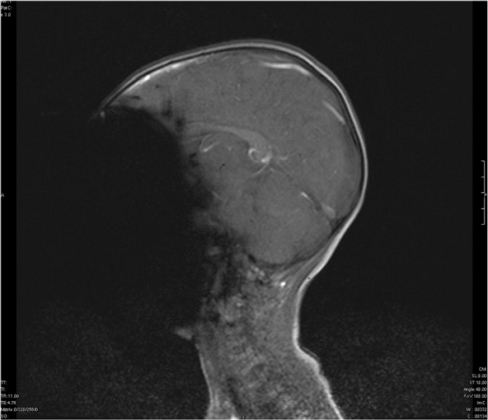 Ferromagnetic Foreign Body