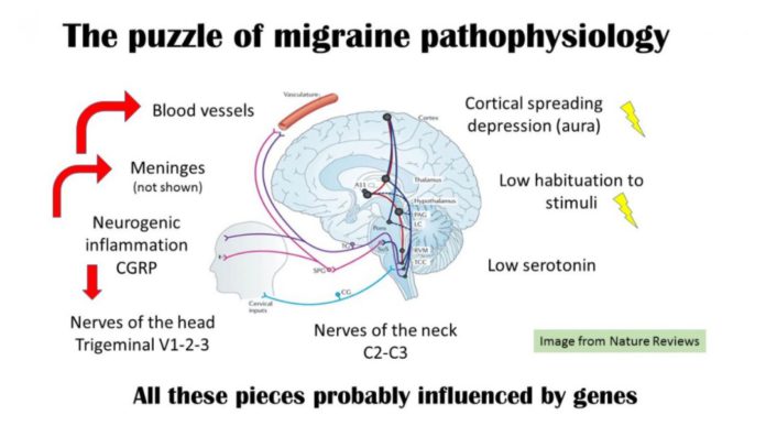 migraine