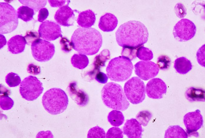 Acute Myeloid Leukemia