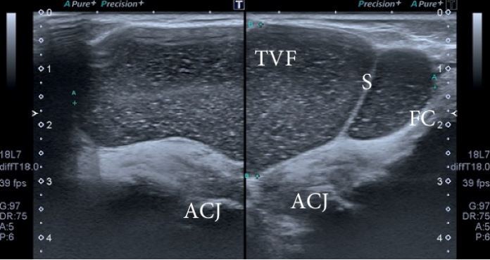 Acromioclavicular Joint Cyst Acromioclavicular Joint Cyst
