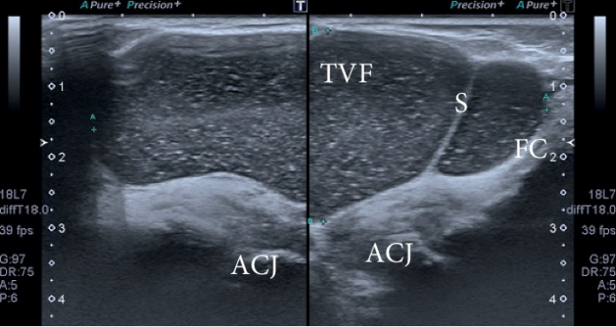 Acromioclavicular Joint Cyst