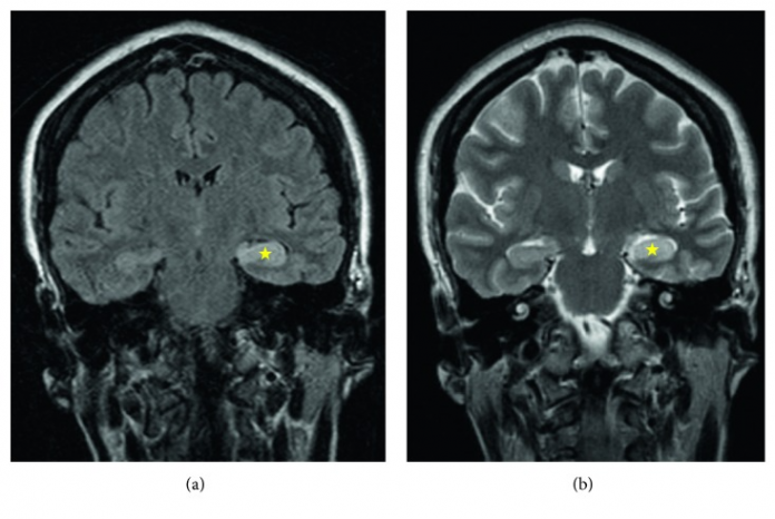 Autoimmune limbic encephalitis