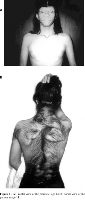 Barber Say Syndrome With Severe Hirsutism of the Back