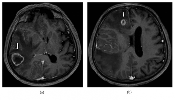 Brain Metastases