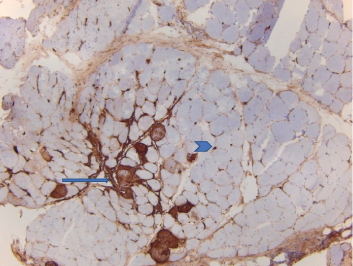 Case of Dermatomyositis in 75-Year-Old