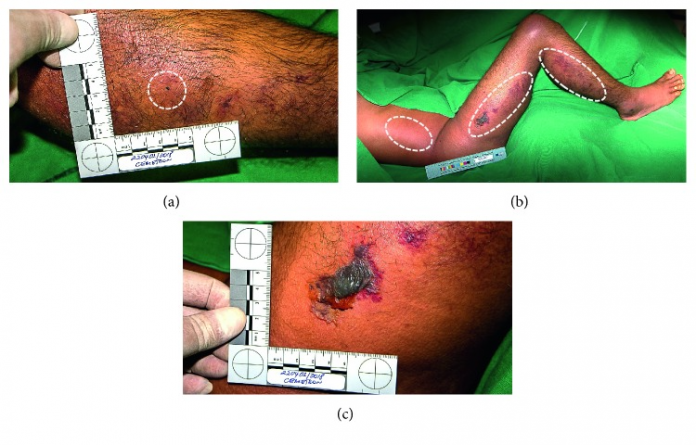 Compartment Syndrome