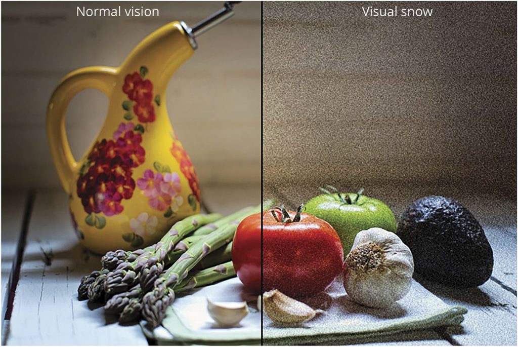 Visual Snow Syndrome