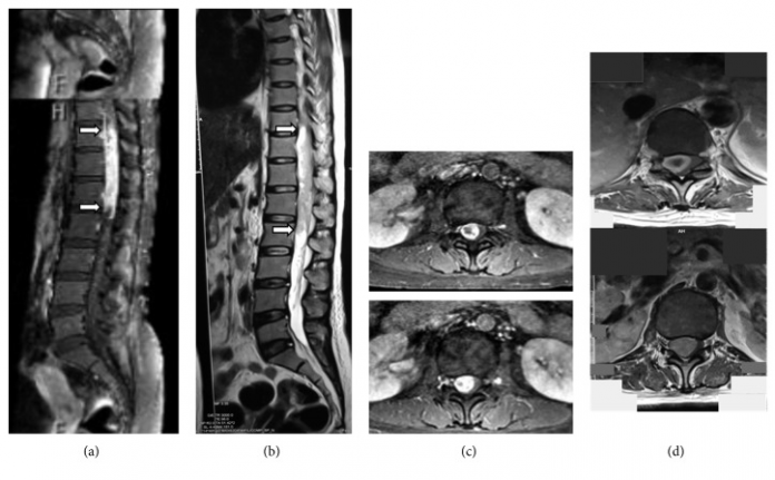 Hemorrhagic Spinal Schwannoma