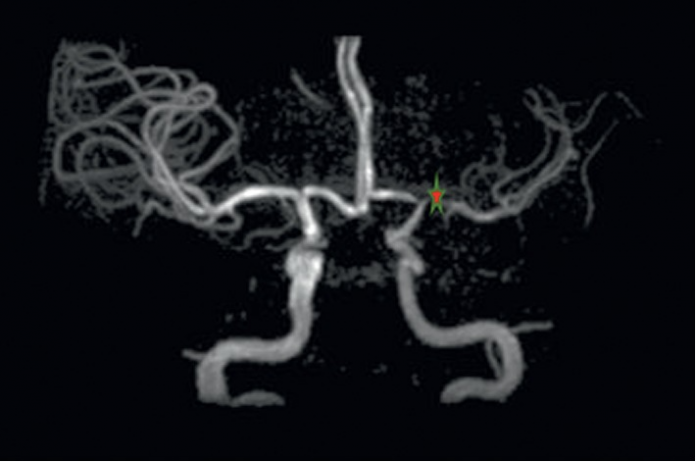 Moyamoya syndrome