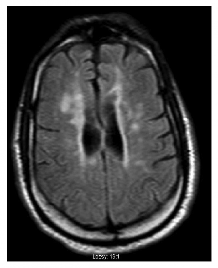 Multiple Sclerosis