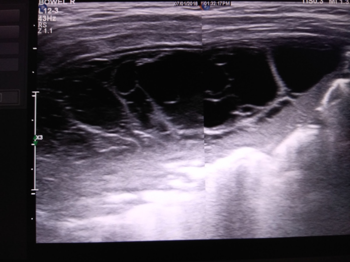 Pleural Empyema Thoracis