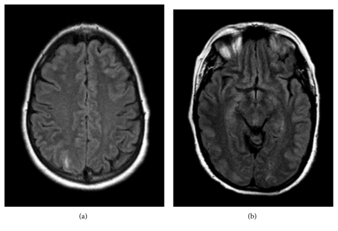 Posterior Reversible Encephalopathy Syndrome