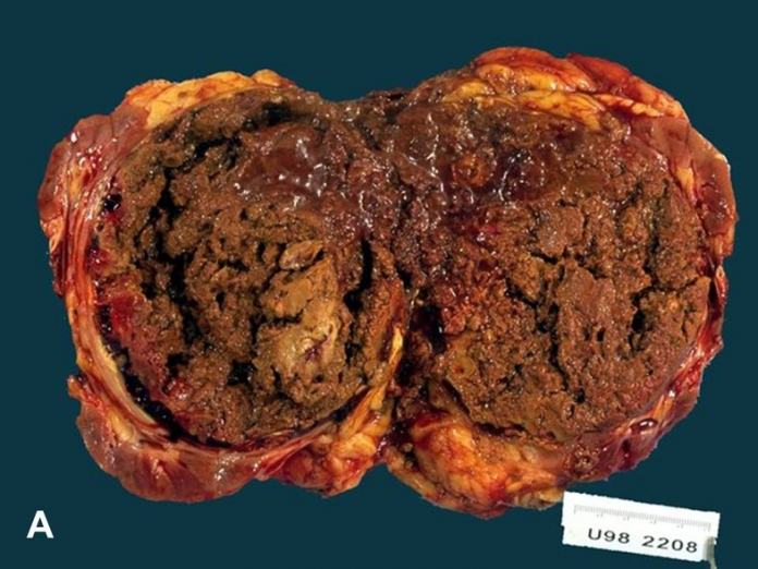 Renal Cell Carcinoma Metastases