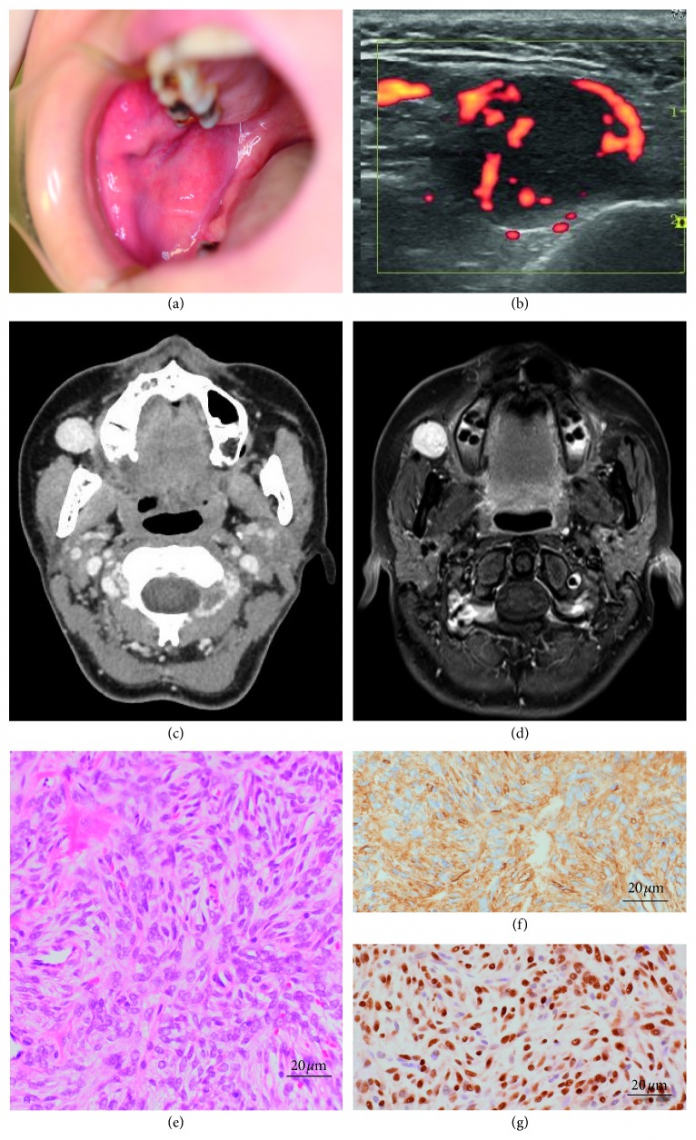 Solitary Fibrous Tumour