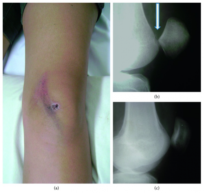 Superior dislocation of the patella