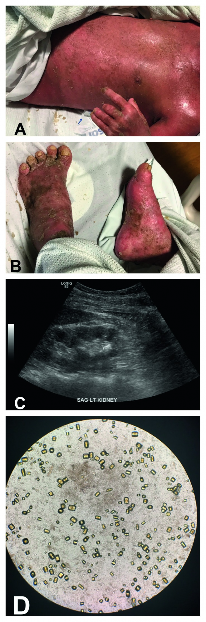 Uric Acid Crystal Nephropathy