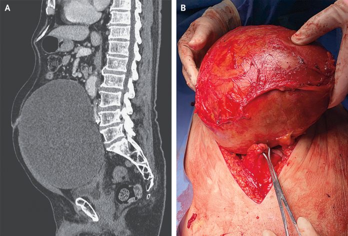 Abdominal distension