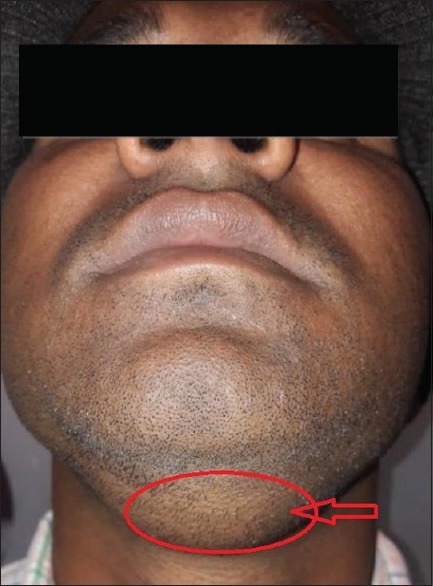 swollen under chin