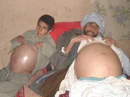 Charmak disease outbreak of 2007 similar to the mysterious disease in Helmand Children