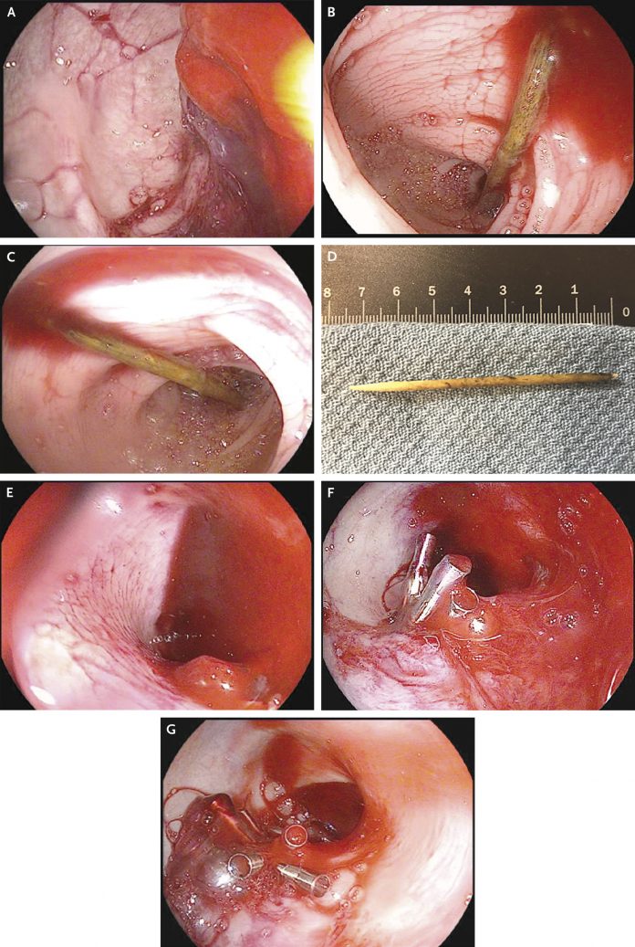 ingested toothpick