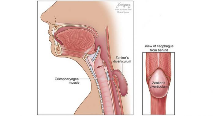 bad breath- Zenker's diverticulum