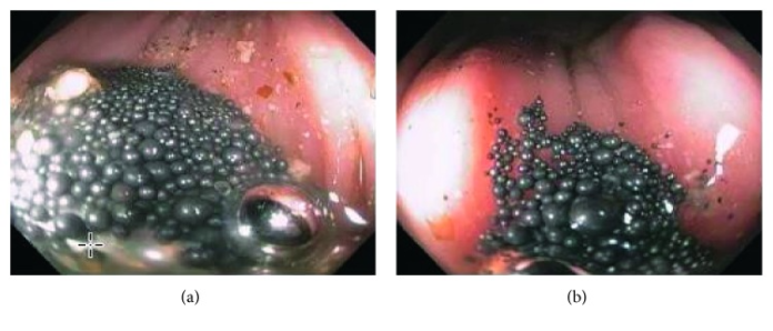 Acute Mercury Toxicity