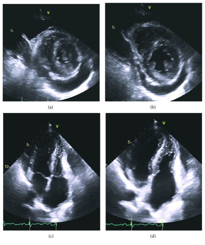 Amyloid cardiomyopathy