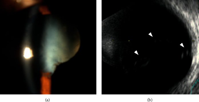 Retinal Detachment