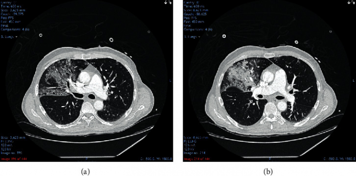 Covid-19 complication