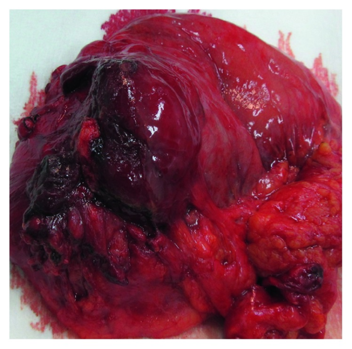 Gastric Schwannoma