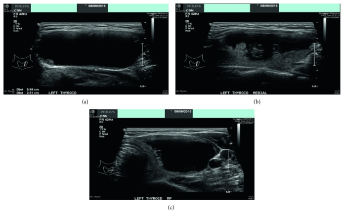 Multifocal Papillary Thyroid Cancer