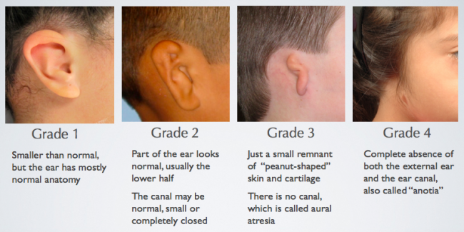 microtia grades