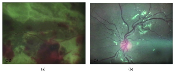 Acute Progressive Vision Loss