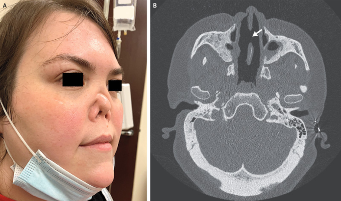 Granulomatosis with Polyangiitis