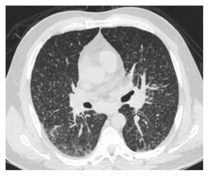 Miliary Histoplasmosis