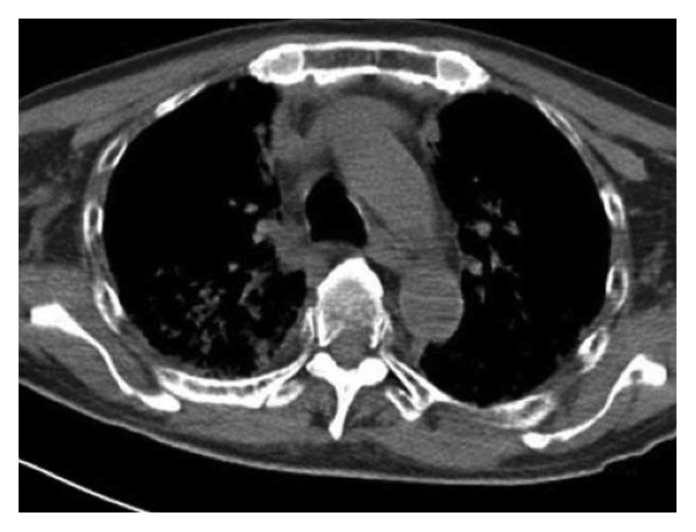 Pulmonary Toxicity Induced by Bortezomib