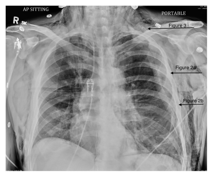 Subcutaneous Emphysema Subcutaneous Emphysema