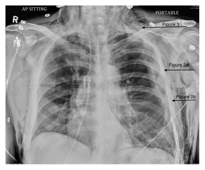 Subcutaneous Emphysema