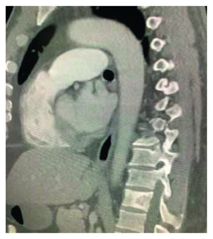 Monophasic Synovial Sarcoma