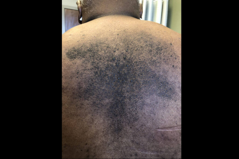 Terra Firma-Forme: Case of Hyperpigmented Plaques on Trunk