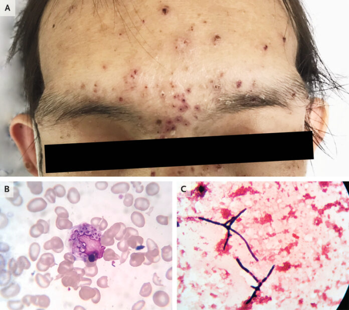 Talaromycosis in HIV positive patient