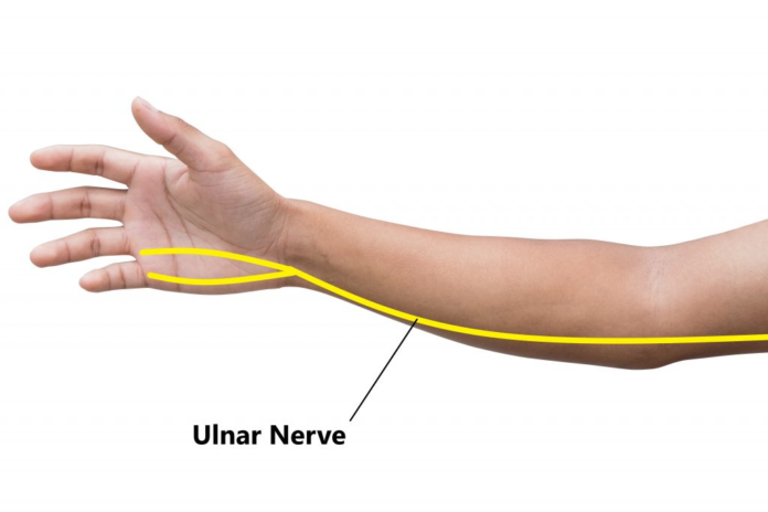 Cubital tunnel syndrome