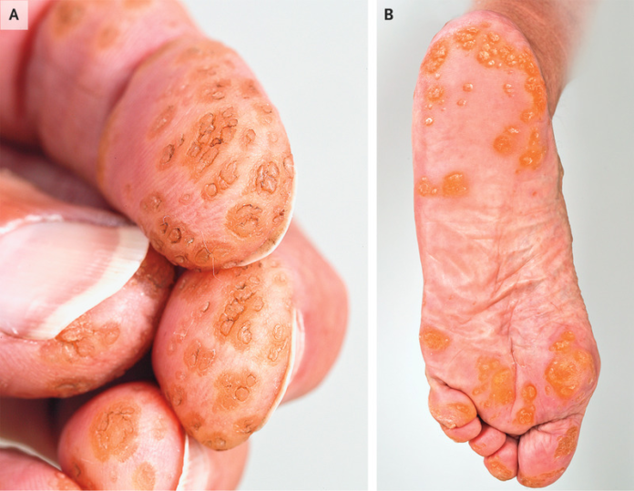 Palmoplantar Papules