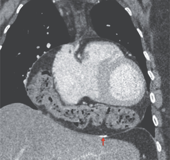 Atypical Presentation of Intrapericardial Colon