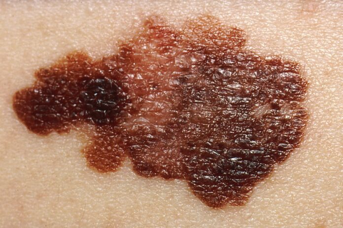 Melanoma